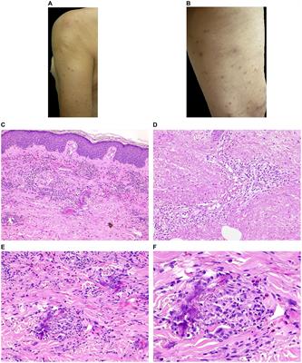 Eosinophilic dermatosis of hematologic malignancy in patients with chronic lymphocytic leukemia/non-Hodgkin’s B lymphoma: a single center prospective clinico-pathological study